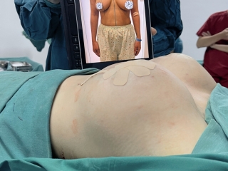 Nâng Treo Ngực Sa Trễ 