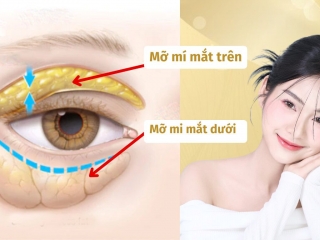 Cách làm tan mỡ mí mắt nhanh chóng và an toàn