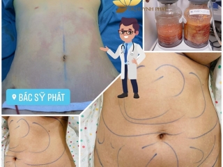 Hút mỡ là gì?