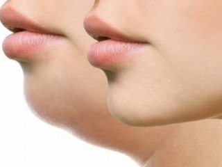 Hút Mỡ Nọng Cằm 