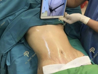 Hút Mỡ Vòng2 - 360 Độ