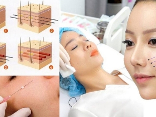 Căng da mặt toàn phần -  BS Thẩm Mỹ HUỲNH PHÁT