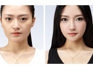 Độn cằm Hạ gò má uy tín tại BS Thẩm Mỹ HUỲNH PHÁT