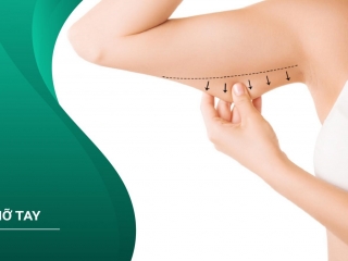 Hút Mỡ Bắp Tay - Những Điều Cần Biết và Lưu Ý