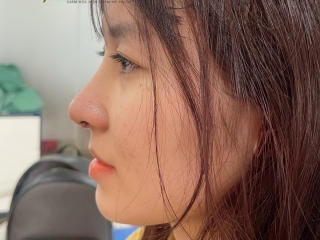 Nâng mũi cấu trúc