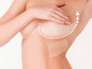 Có nên nâng ngực không và cần lưu ý những gì trước khi nâng?
