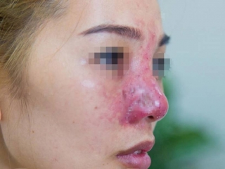 [LƯU Ý] Dấu hiệu nâng mũi bị viêm có thể bạn chưa biết