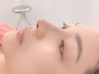 Nâng mũi sụn Surgiform có thần kỳ như lời đồn?