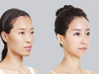 Tạo má baby