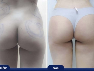 Cấy Mỡ Tự Thân Vùng Mông 
