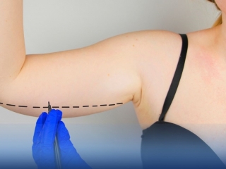 Hút Mỡ Bắp Tay: Giải Pháp Loại Bỏ Mỡ Thừa Vĩnh Viễn
