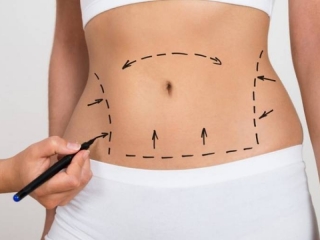 Hút mỡ - Điêu khắc body: Định hình vóc dáng hoàn hảo