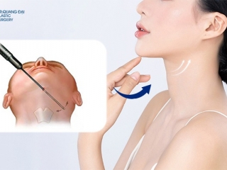 Hút Mỡ Nọng Cằm: Giải Pháp Toàn Diện Cho Vùng Cổ Thanh Thoát