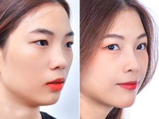 Nâng Mũi Tự Nhiên: Bí Quyết Sở Hữu Dáng Mũi Hoàn Hảo Hài Hòa Khuôn Mặt