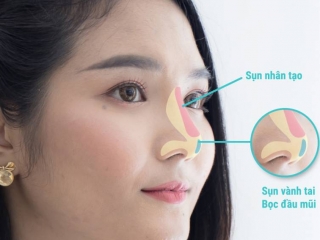 Nâng mũi bao lâu thì đầu mũi hết to ? Kinh nghiệm hậu nâng mũi
