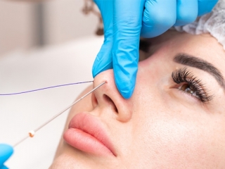 Nâng Mũi Chỉ Collagen: Toàn Bộ Thông Tin Cần Biết Trước Khi Thực Hiện