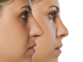 Nâng Mũi Không Phẫu Thuật: Giải Pháp Hoàn Hảo Cho Dáng Mũi Đẹp