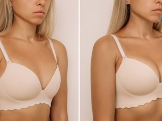 Nâng Cấp Vòng 1 Không Phẫu Thuật: Tổng Quan & Giải Pháp Tự Nhiên