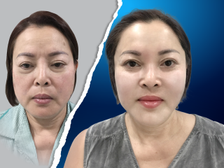 Căng Da Mặt Phẫu Thuật: Giải Pháp Toàn Diện Cho Làn Da Lão Hóa