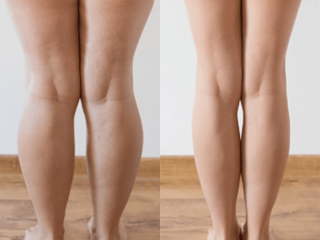 Hút Mỡ Bắp Chân: Giải Pháp Tối Ưu Và Toàn Diện Cho Đôi Chân Thon Gọn