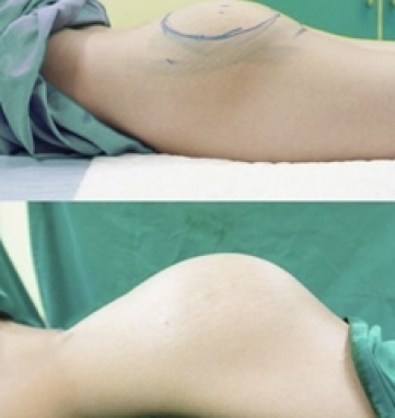 Phẫu Thuật Đặt Túi Nâng Mông