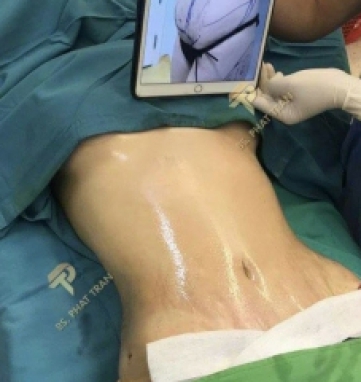 Hút Mỡ Vòng2 - 360 Độ