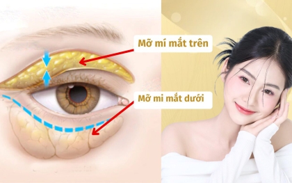 Cách làm tan mỡ mí mắt nhanh chóng và an toàn