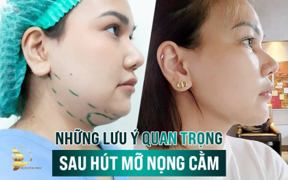 Hút Mỡ Nọng Cằm - Loại Bỏ Mỡ Thừa Tạo Cằm V-line và Những Điều Lưu ý Quan Trọng