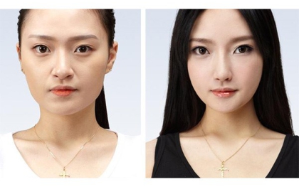Độn cằm Hạ gò má uy tín tại BS Thẩm Mỹ HUỲNH PHÁT
