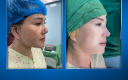 Độn Cằm: Từ A-Z Các Phương Pháp, Quy Trình Và Bí Quyết