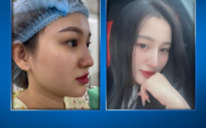 Hút Mỡ Nọng Cằm: Giải Pháp Toàn Diện Cho Vùng Cổ Thanh Thoát