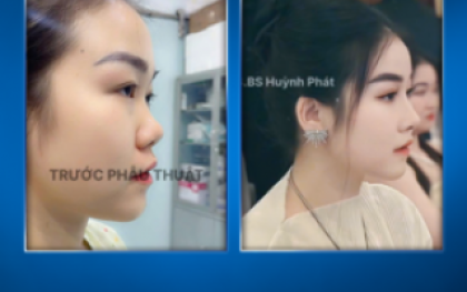 Căng Da Mặt Phẫu Thuật: Giải Pháp Toàn Diện Cho Làn Da Lão Hóa