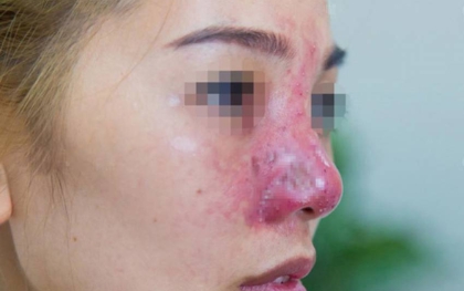 [LƯU Ý] Dấu hiệu nâng mũi bị viêm có thể bạn chưa biết