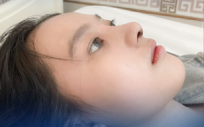 Nâng Mũi Chỉ: Giải Pháp Làm Đẹp Mũi Không Phẫu Thuật Có An Toàn Không?