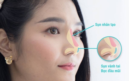 Nâng mũi bao lâu thì đầu mũi hết to ? Kinh nghiệm hậu nâng mũi